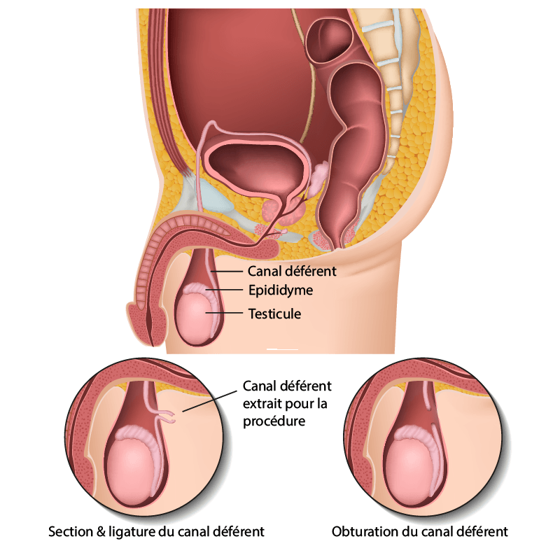 Schéma des voies génitales mâles et de la vasectomie