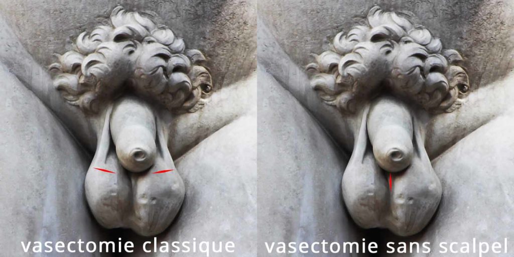 Comparaison des techniques de vasectomie